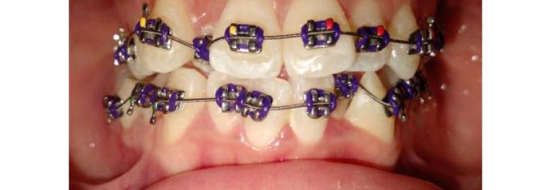 Affordable Dental Braces by E.L.T dental clinic
